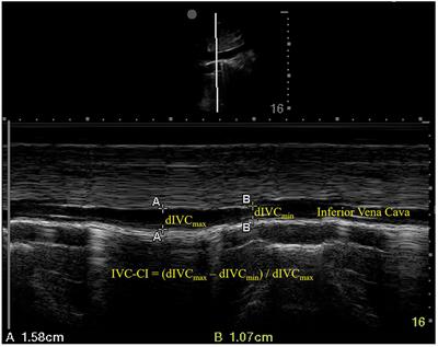 Maximum inferior vena cava diameter predicts post-induction hypotension in hypertensive patients undergoing non-cardiac surgery under general anesthesia: A prospective cohort study